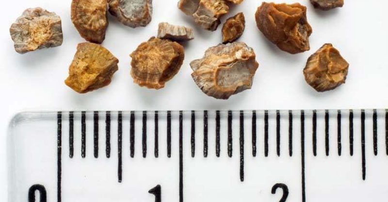 Potassium Citrate treats Kidney Stones